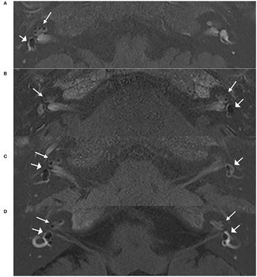 Characteristics of clinical details and endolymphatic hydrops in unilateral and bilateral Ménière's disease in a single Asian group